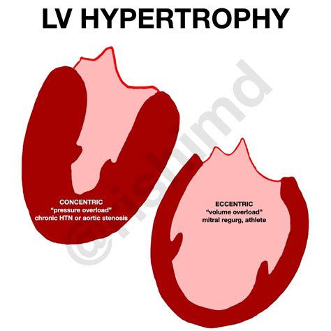 concentric lv hypertrophy|concentric vs eccentric ventricular hypertrophy.